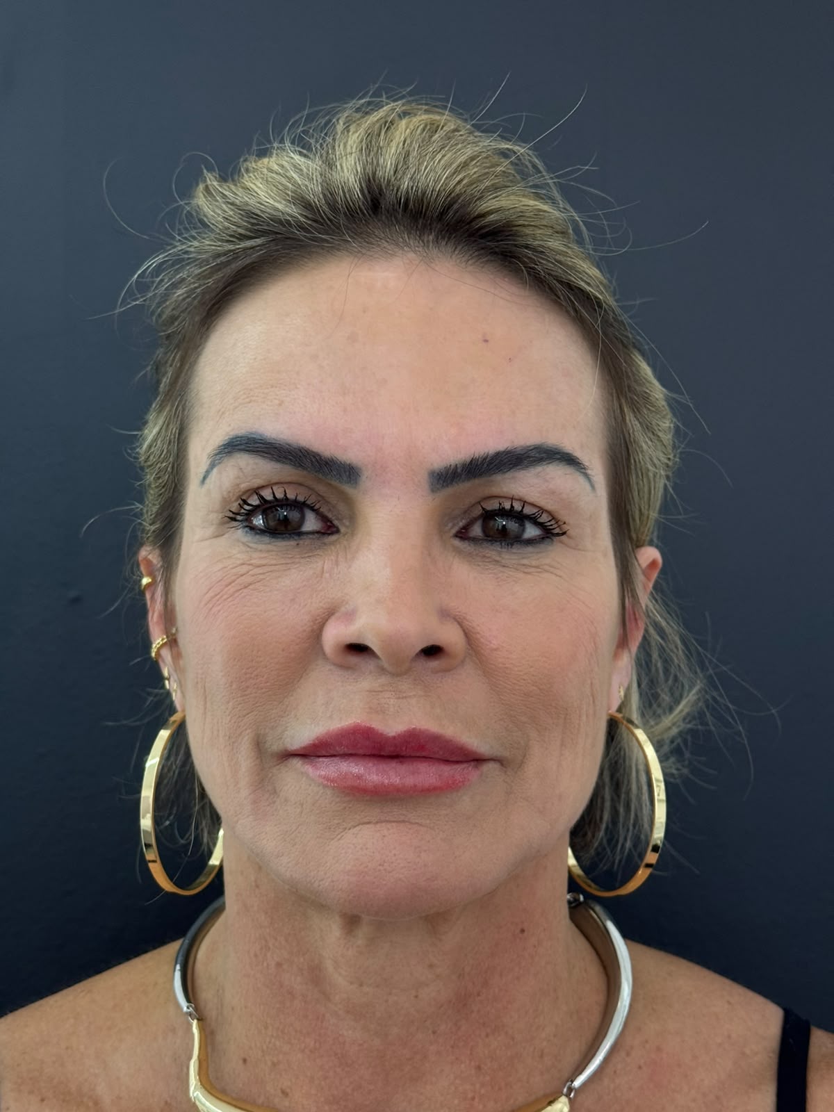Depois do planejamento facial global, vista frontal