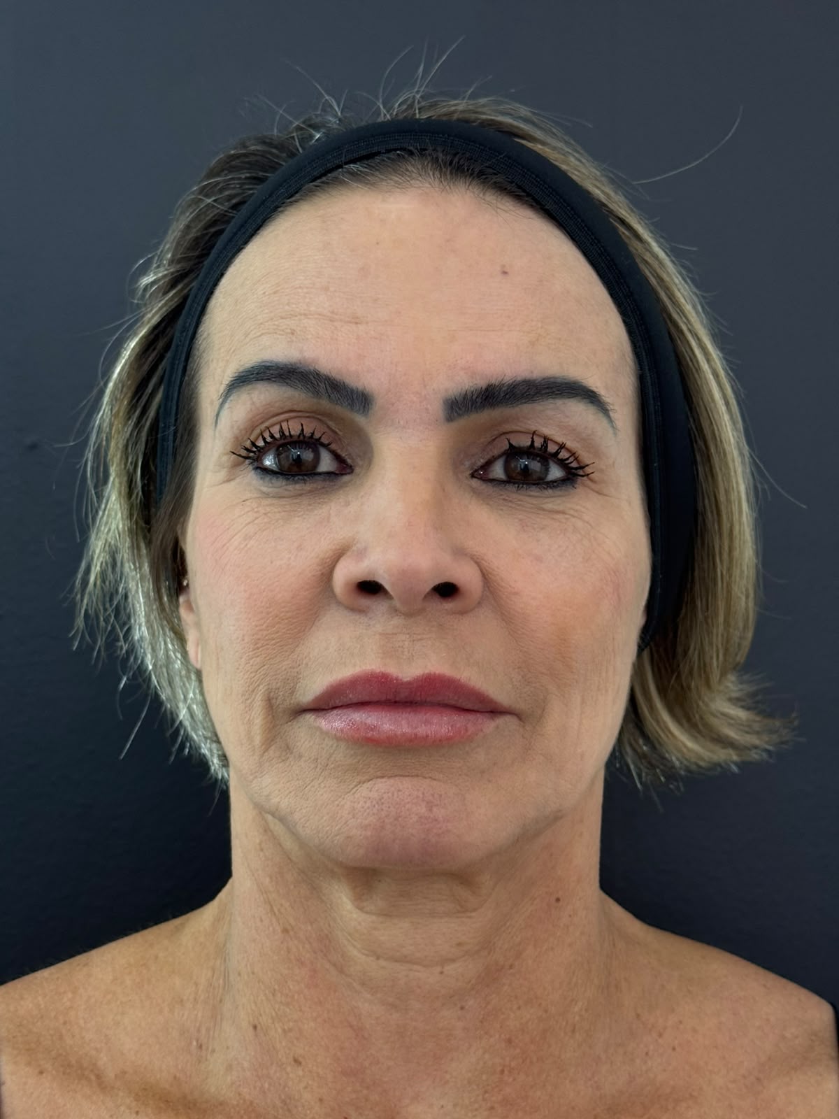 Antes do planejamento facial global, vista frontal