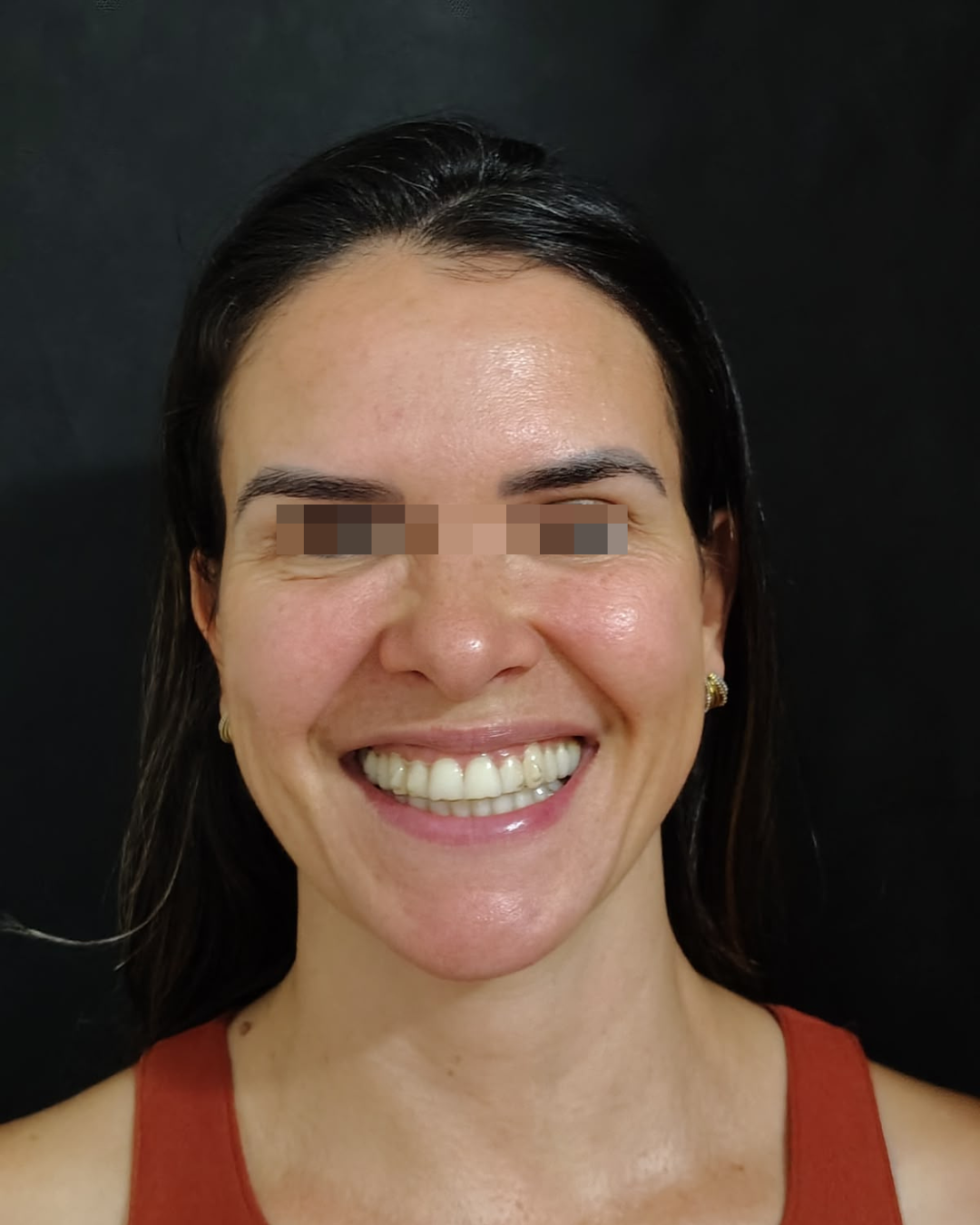 Depois do tratamento com toxina botulínica, paciente sorrindo