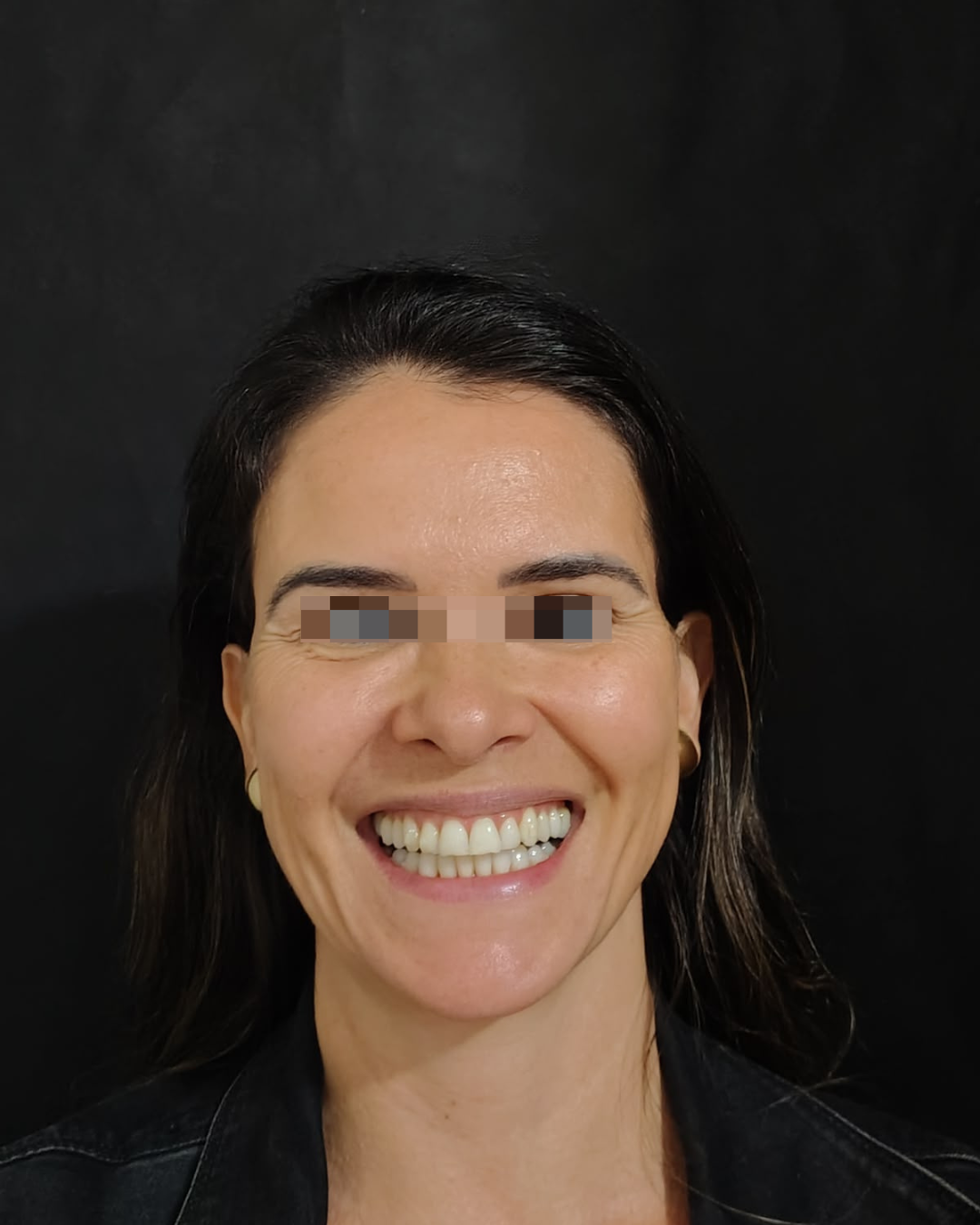 Antes do tratamento com toxina botulínica, paciente sorrindo
