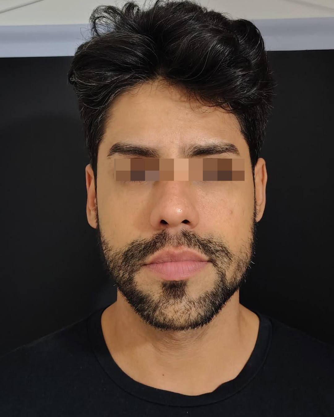 Depois do caso facial masculino, vista frontal