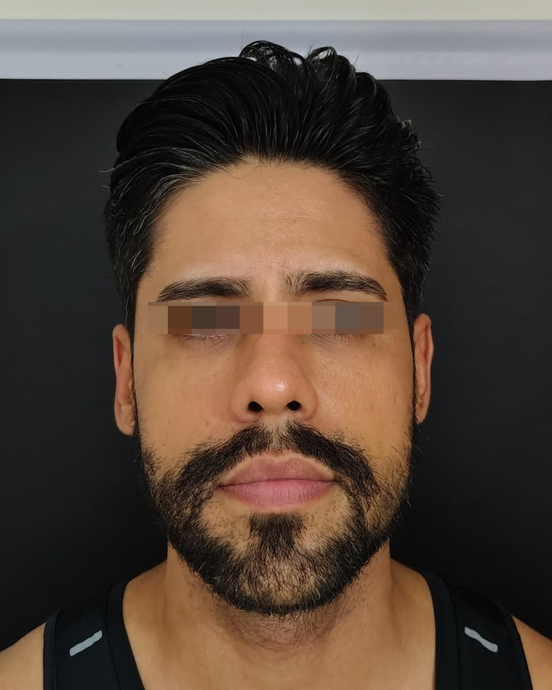 Antes do caso facial masculino, vista frontal