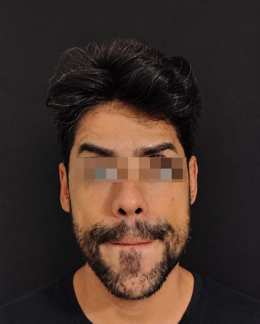 Depois do caso facial masculino, vista frontal