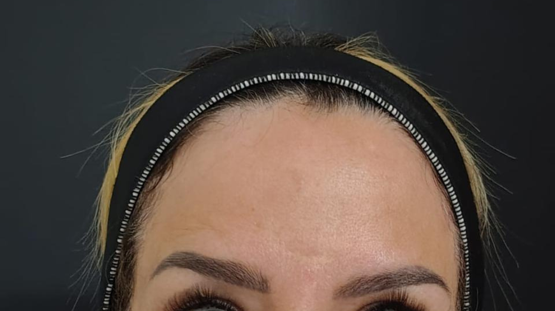 Depois, detalhe das linhas da testa