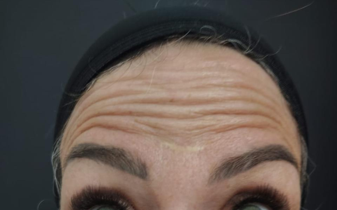 Antes, detalhe das linhas da testa
