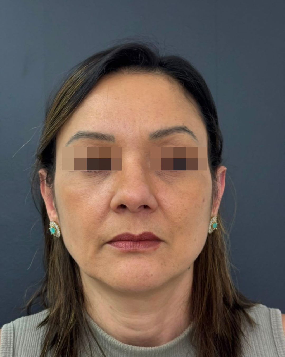 Depois do tratamento de rejuvenescimento facial, vista frontal