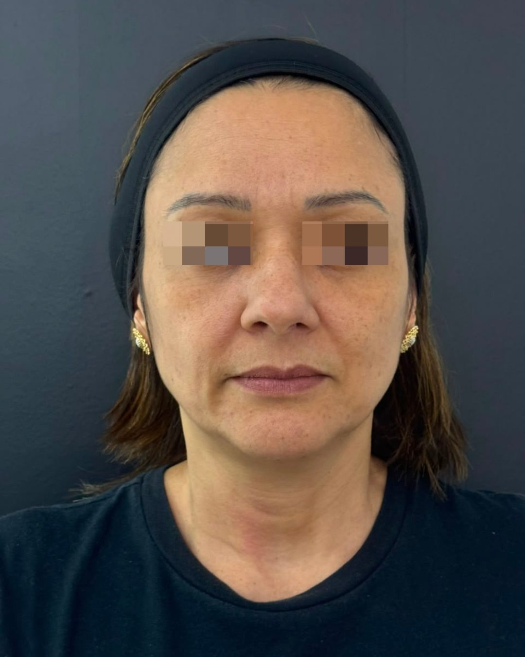 Antes do tratamento de rejuvenescimento facial, vista frontal